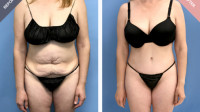 Tummy Tuck