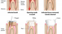 Root Canal